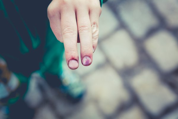 Contusions musculaires : Causes, soins et précautions pour une guérison rapide